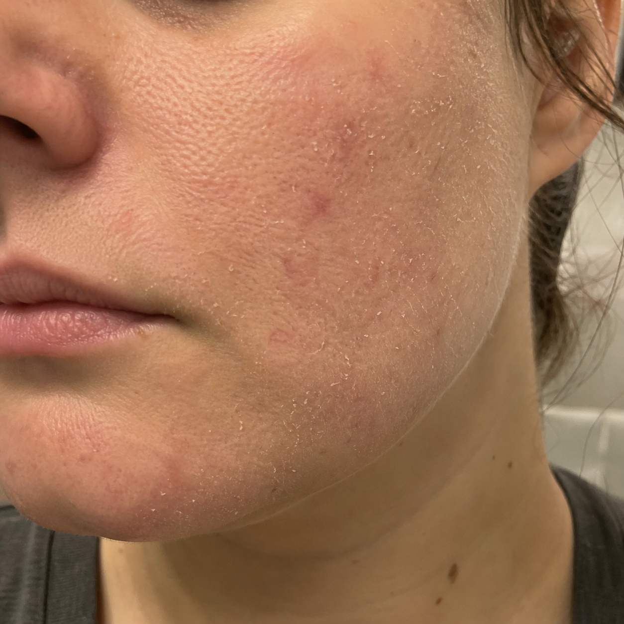 Before - Face
